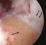 Autologous Peripheral Blood Stem Cell Therapy for Chronic Achilles Tendinopathy: Report of Three Cases