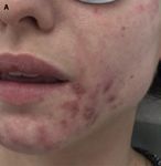 Dermatology Practical & Conceptual - Ablative Fractional Erbium:YAG Laser Resurfacing: A Treatment Option for Acne