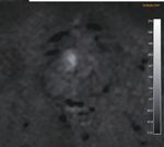 Why Is a b-value Range of 1500-2000 s/mm2 Optimal for Evaluating Prostatic Index Lesions on Synthetic Diffusion-Weighted Imaging?