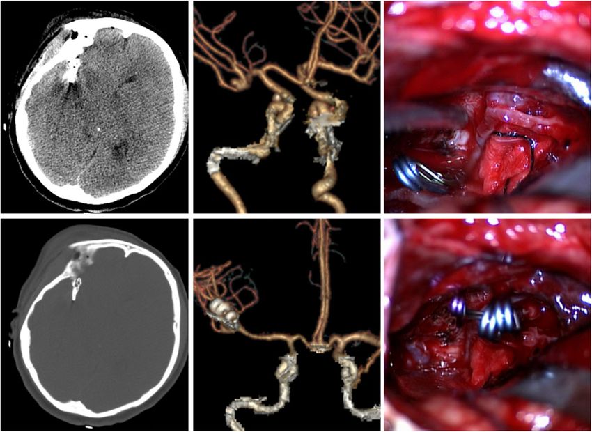 Reconstruction clipping of ruptured anterior circulation aneurysms via ...