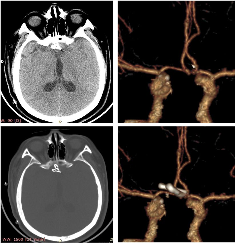 Reconstruction clipping of ruptured anterior circulation aneurysms via ...