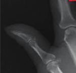 Case Report Hypertrophic Osteoarthropathy: A Secondary Manifestation of Malignant Melanoma