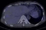 Transarterial Radioembolization as an Effective Local Treatment Modality for Liver Metastasis of Thyroid Cancer