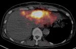 Transarterial Radioembolization as an Effective Local Treatment Modality for Liver Metastasis of Thyroid Cancer