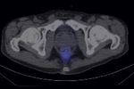 Transarterial Radioembolization as an Effective Local Treatment Modality for Liver Metastasis of Thyroid Cancer