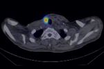 Transarterial Radioembolization as an Effective Local Treatment Modality for Liver Metastasis of Thyroid Cancer