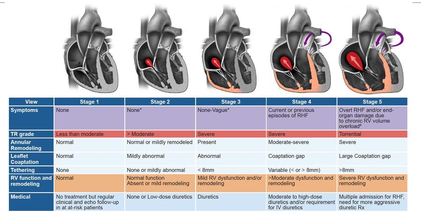 Tricuspid Valve - Where are we? - Miami Valves 2023 - Azeem Latib MD