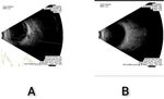 Caterpillar hair-induced ophthalmitis causing exudative retinal detachment