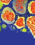 Case Report Metastatic Thyroid Cancer Presenting as Renal Cortical Mass