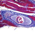 Case Report Metastatic Thyroid Cancer Presenting as Renal Cortical Mass