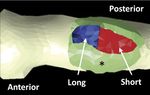 Partial Distal Biceps Avulsion Results in a Significant Loss of Supination Force