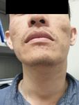 Extranasopharyngeal Angiofibroma from Hypopharynx: a Rare Case Report