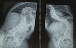 Neurofibromatosis type 1 manifesting with adolescent idiopathic scoliosis: a case report and literature review