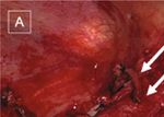 Case Report Undifferentiated Embryonal Sarcoma of the Liver Involving All Major Hepatic Veins Treated by Left Extended Trisectionectomy