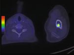 Case Report Undifferentiated Embryonal Sarcoma of the Liver Involving All Major Hepatic Veins Treated by Left Extended Trisectionectomy