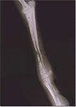 Treatment of a Radio-Ulnar Atrophic Pseudoarthrosis in a Toy Poodle Using an Autologous Coccygeal Vertebrae Transfer and Plate Fixation