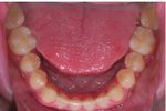 Closure of an open bite using the 'Mousetrap' appliance: a 3-year follow-up - Exeley
