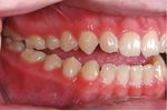 Closure of an open bite using the 'Mousetrap' appliance: a 3-year follow-up - Exeley