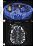 Challenges of Diagnosing Primary Ewing's Sarcoma in the Small Intestine of the Elderly: A Case Report