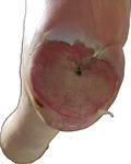 Recurrent Blister Formation in Setting of Poorly Managed Diabetes Mellitus - Cureus