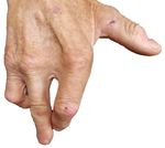 Recurrent Blister Formation in Setting of Poorly Managed Diabetes Mellitus - Cureus