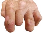 Recurrent Blister Formation in Setting of Poorly Managed Diabetes Mellitus - Cureus
