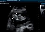 Ultrasound diagnosis of acrania with major low-lying placenta and polyhydramnios; case report