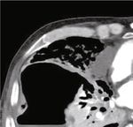 Case Report Lung Abscess with a Refractory Bronchopleural Fistula Saved from Potentially Fatal Sepsis by Omentoplasty and Extracorporeal Membrane ...