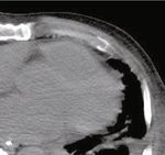 Case Report Lung Abscess with a Refractory Bronchopleural Fistula Saved from Potentially Fatal Sepsis by Omentoplasty and Extracorporeal Membrane ...