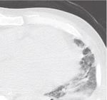 Case Report Lung Abscess with a Refractory Bronchopleural Fistula Saved from Potentially Fatal Sepsis by Omentoplasty and Extracorporeal Membrane ...