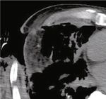 Case Report Lung Abscess with a Refractory Bronchopleural Fistula Saved from Potentially Fatal Sepsis by Omentoplasty and Extracorporeal Membrane ...