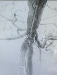 THERAPEUTIC CHALLENGE - Immediate outcome of endovascular treatment of ruptured juxtarenal aneurysm with parallel stents